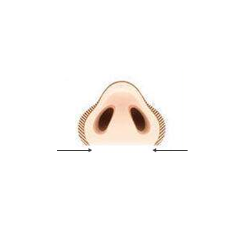 鼻翼縮小
